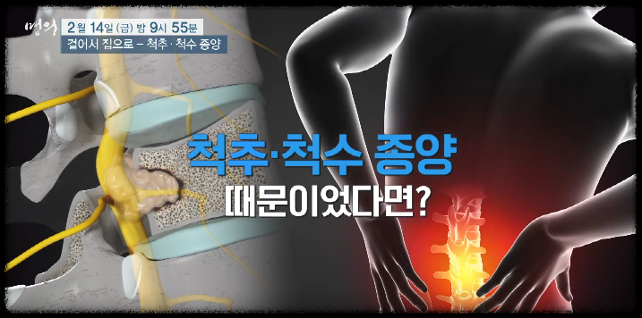 척추척수 종양