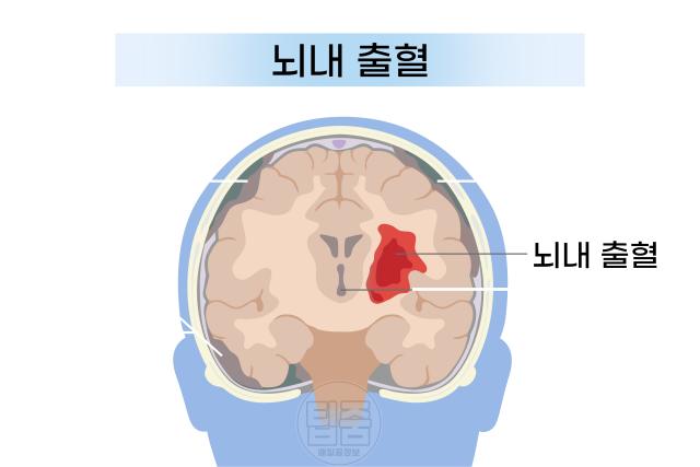 뇌혈관 터짐 위치 뇌출혈 종류 뇌내출혈
