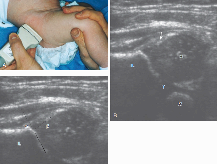 소아에서 엉덩관절 형성이상을 위한 검사