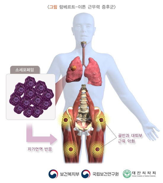 람베르트-이튼 증후군