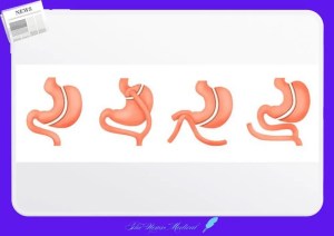 비만대사수술의 종류에는 위소매절제술, 루와이 위우회술, 십이지장우회술, 근위소장(공장)우위술 등이 있다.