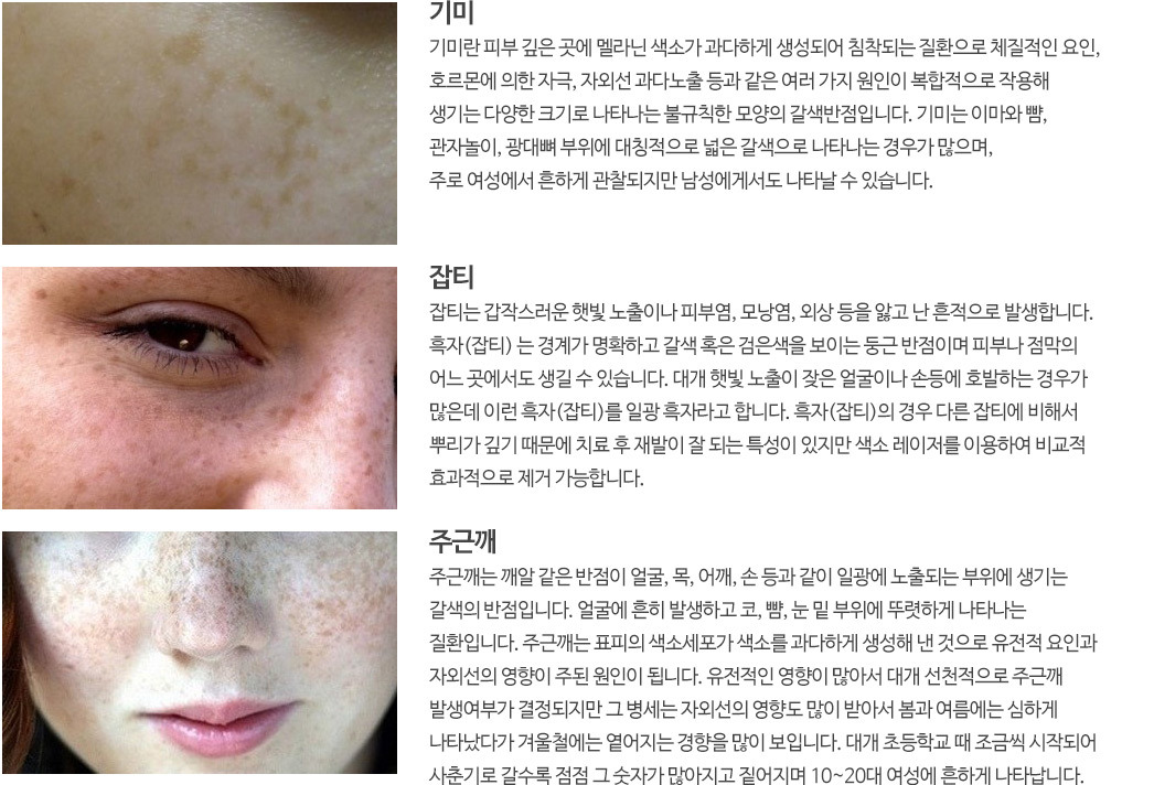 기미, 잡티, 주근깨 이미지와 피부 색소 질환 특징