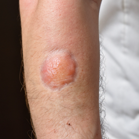 3. 잘못된 화상 물집 치료 피하기