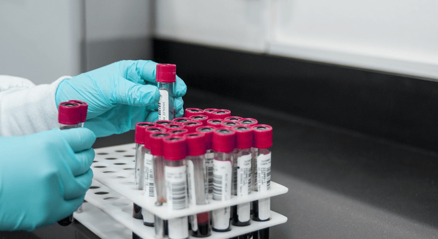 혈액 검사를 위해 앰플을 정리하고 있는 모습