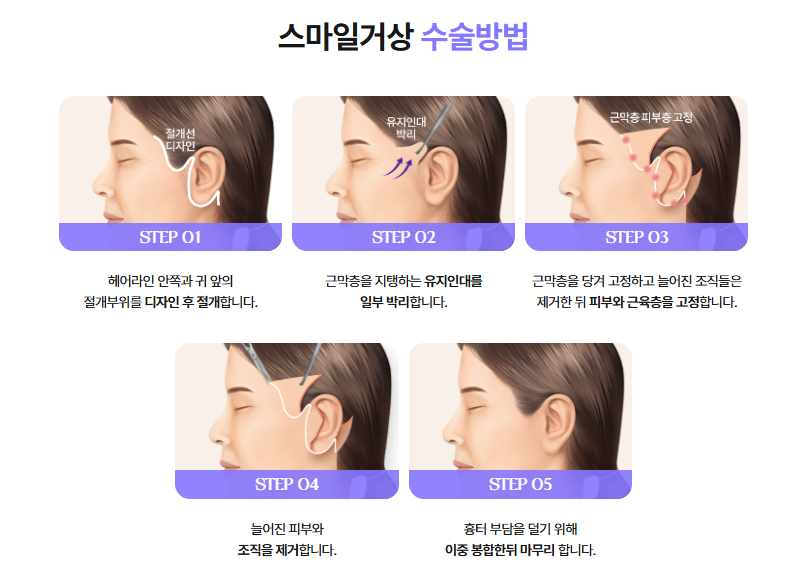 스마일리프팅가격 스마일거상