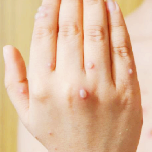 홍역 관련주 대장주 테마주 수혜주 TOP5