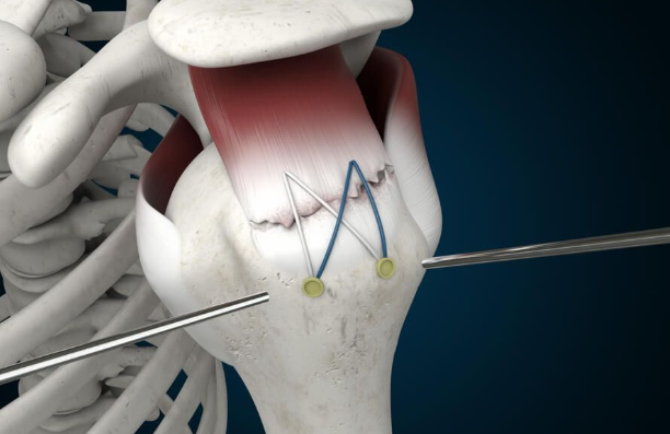 회전근개파열 수술후 회복기간