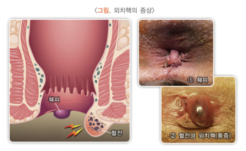 외치핵의 증상