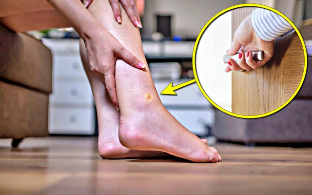 종아리 굵기 건강, 종아리 상처, 팁줌