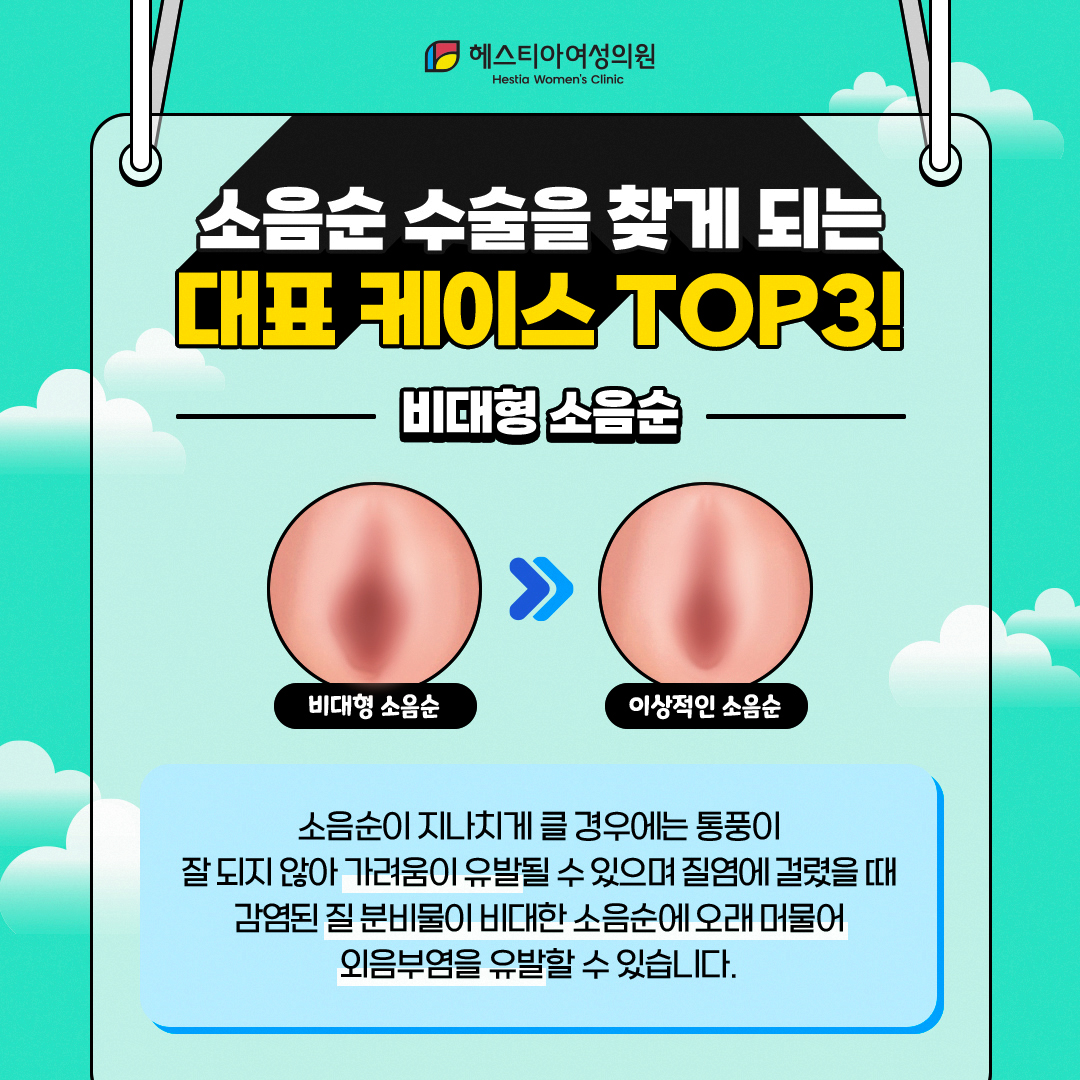 비대형소음순