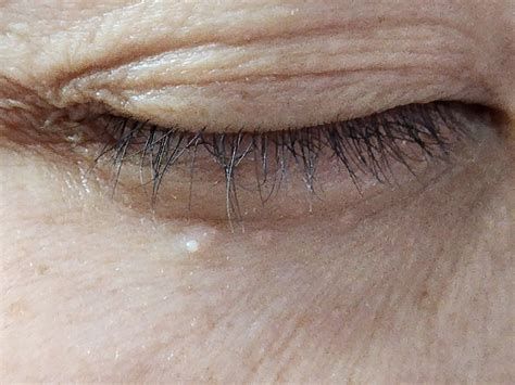 눈비립 종 제거