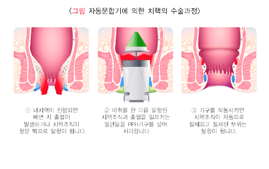 치핵 수술 과정