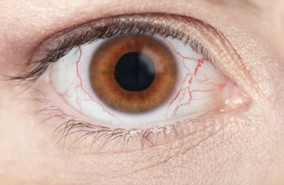 눈에 실핏줄