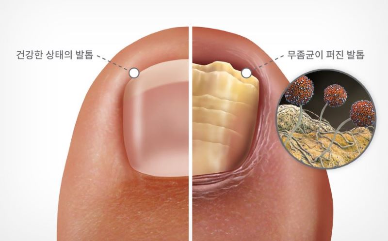 무좀 원인과 감염 경로