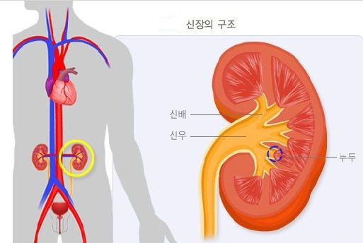 급성 신우신염 증상