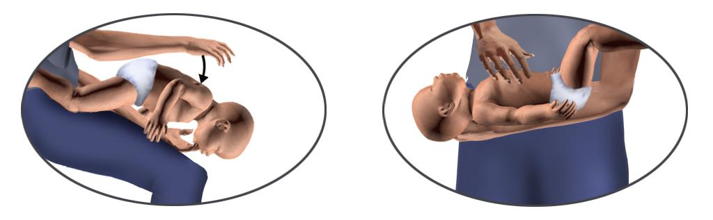 생후 12개월 미만 하임리히법