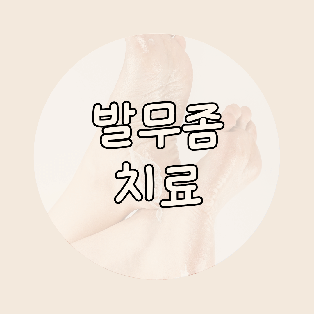발무좀 치료
