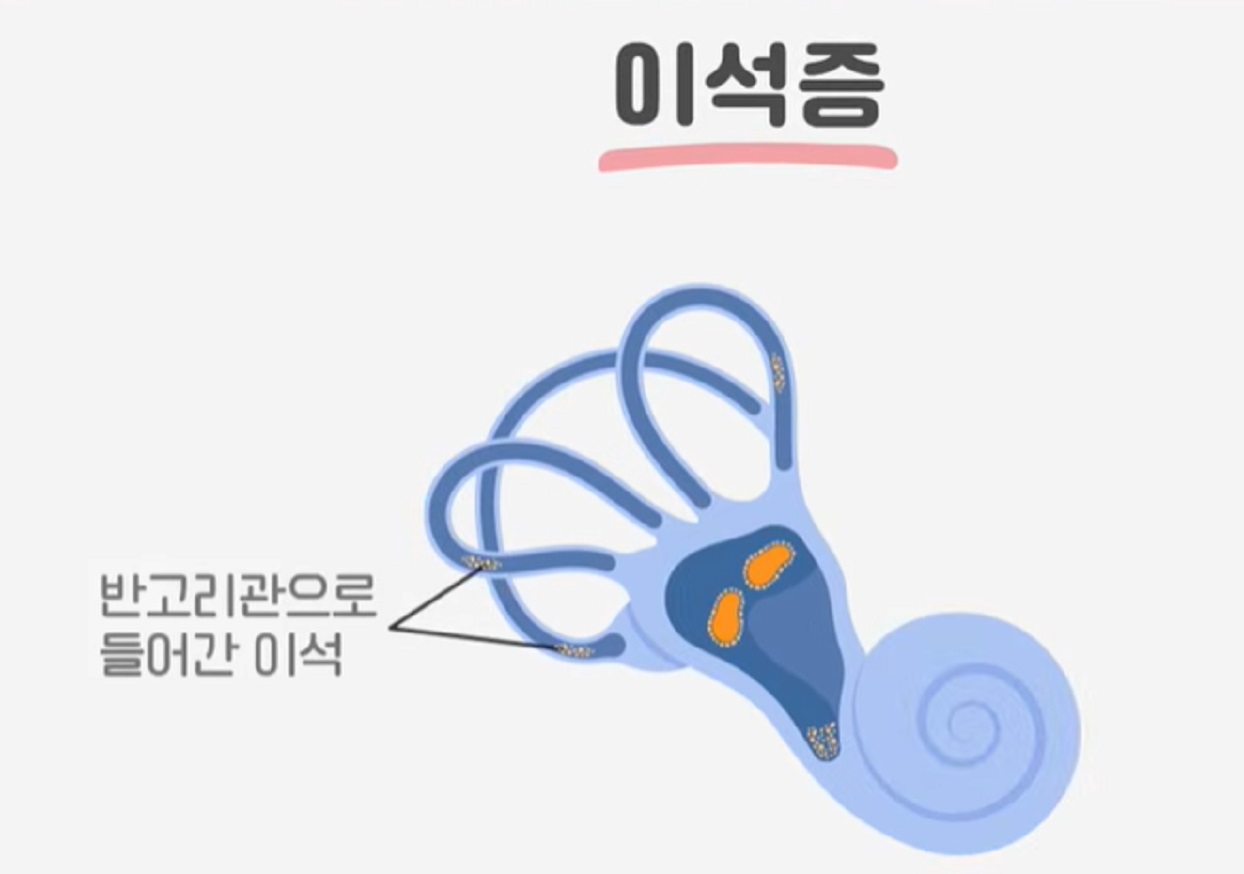 이석증-명의-서재현교수