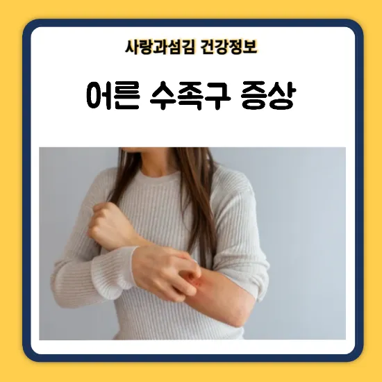 수족구 어른 전염에 대한 원인과 예방법 정리_8