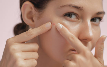 여드름 잘못 짜기