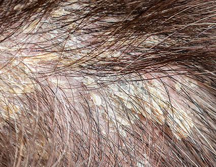 적절한 샴푸와 생활습관을 적용