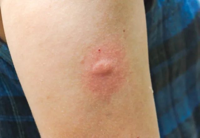 모기 물려 가려울 때 땀띠에 안티푸라민 연고 효능 부작용 사용후기_2