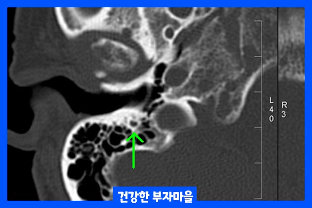 뼈통증, 열, 쉽게 골절 되는 뼈 증상