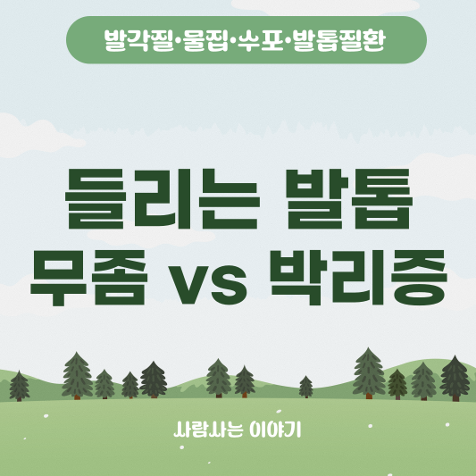 하얗게 들리는 발톱, 무좀일까? 박리증일까? 구별법과 대처법
