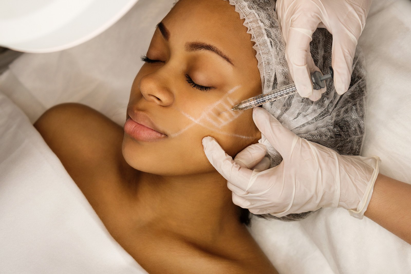 애플존 필러 &ndash; 중안부 볼륨을 채워 얼굴 축소 효과