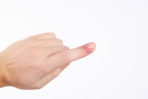 손톱 가시래기 손 까시래기 손 거스러미