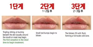 입술헤르페스(구순포진)란?