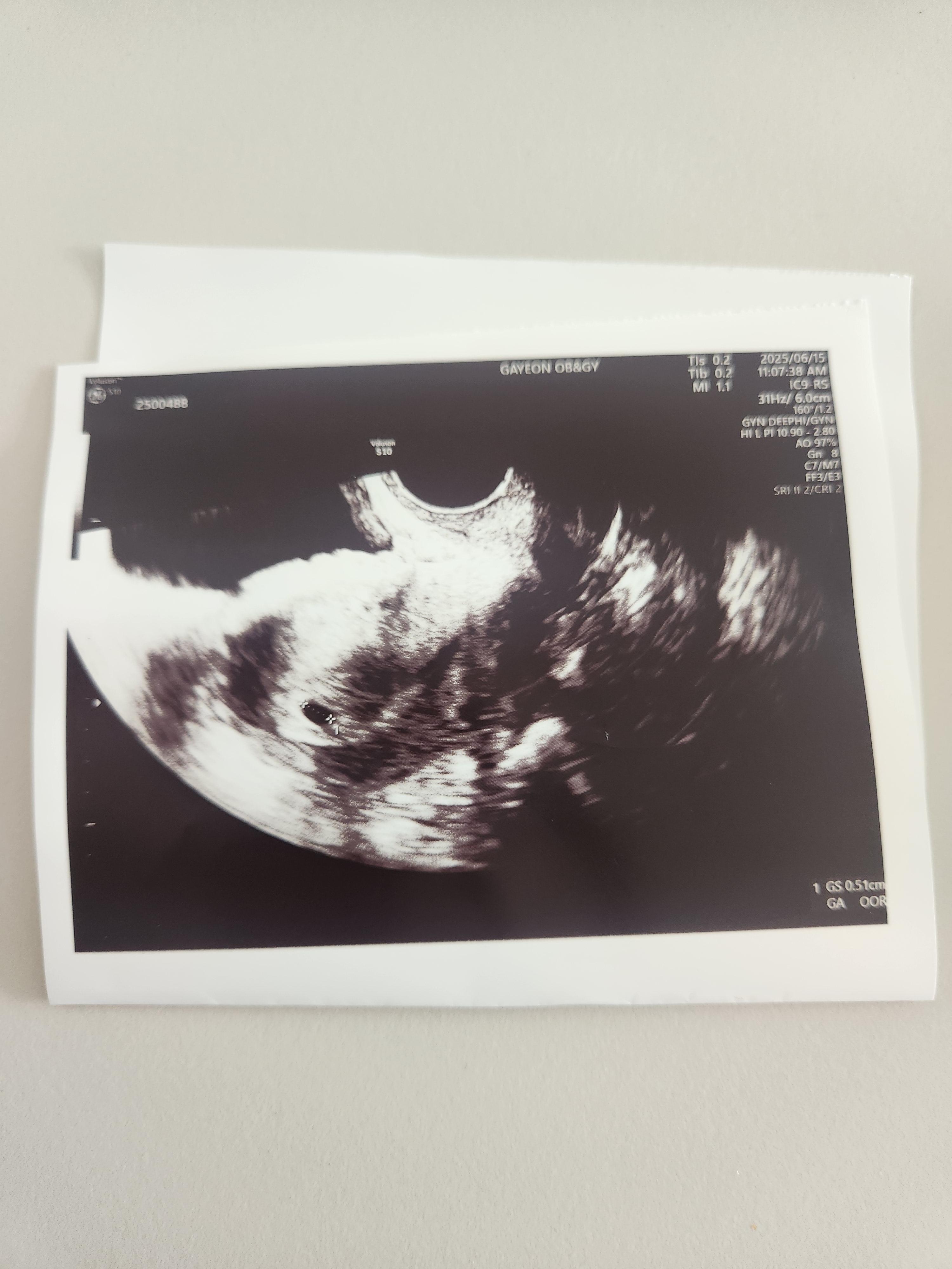 아기집 초음파, 임신5주차 초음파