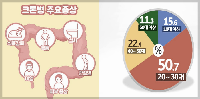 크론병증상-젊은층발병률