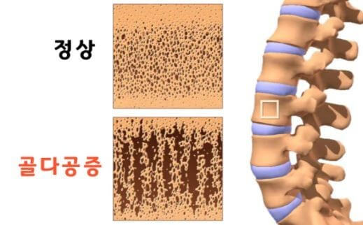 골다공증 환자 뼈의 밀도