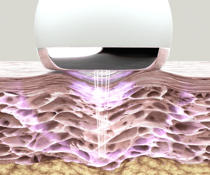 고주파 마시지기 원리