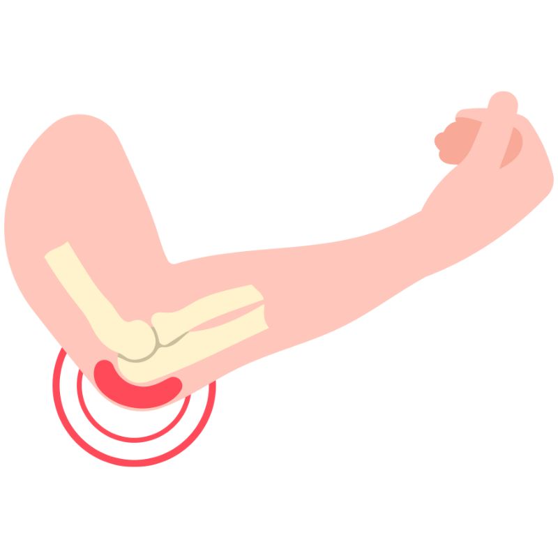 팔꿈치 물혹