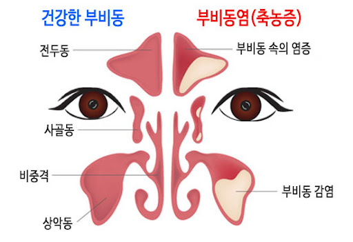 부비동염(축농증)