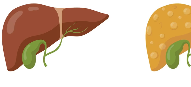 지방간 질환의 치료법은 무엇인가요?