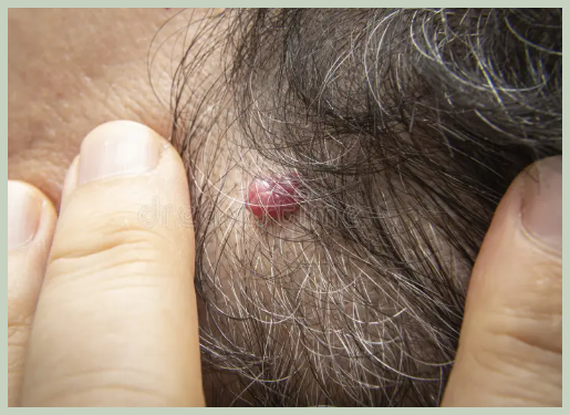 체리 혈관종 예방법