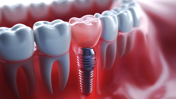어금니 임플란트 가격