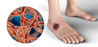 패혈증이란 무엇인지 원인 증상 치료 예방법_24