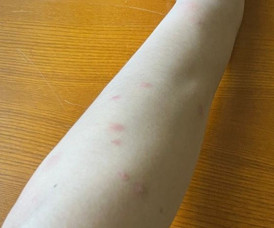 계명대학교 기숙사 등에서 빈대로 인해 피해 사례가 늘어 대학 측이 방역 조치를 실시했다. 사진은 빈대에 물렸다고 주장하는 재학생의 팔. [사진=계명대학교 에브리타임 캡처]