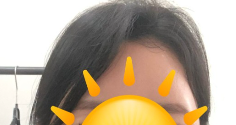 측두근 보톡스
