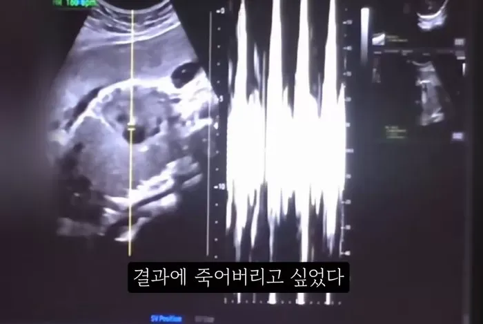 낙태-과정-영상