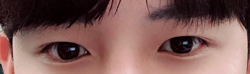 안검하수 후기