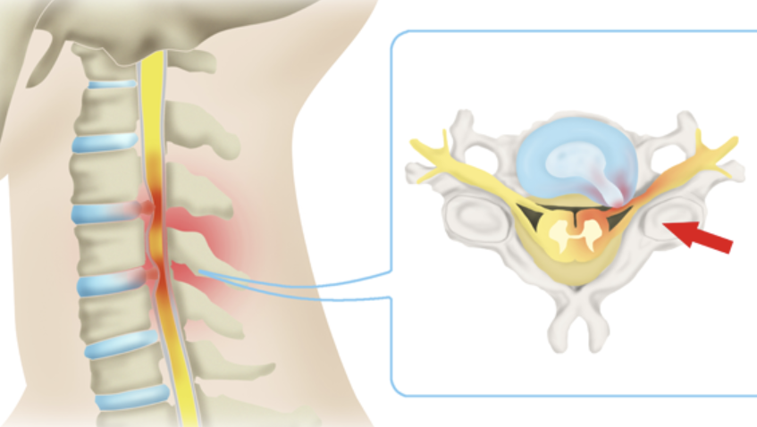 목디스크 치료, 증상 섬네일