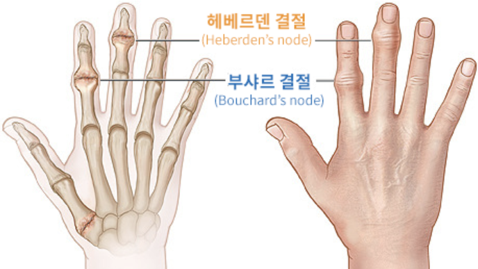 손가락 관절염 증상, 치료법 섬네일
