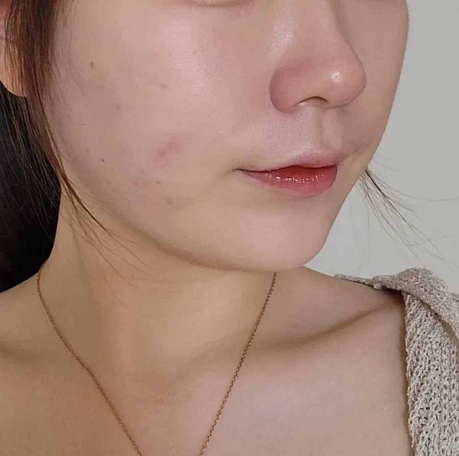 bbl 레이저 후기