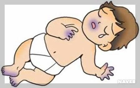 호흡기 질환: 청색증- 종류, 증상, 원인, 진단방법, 치료방법.