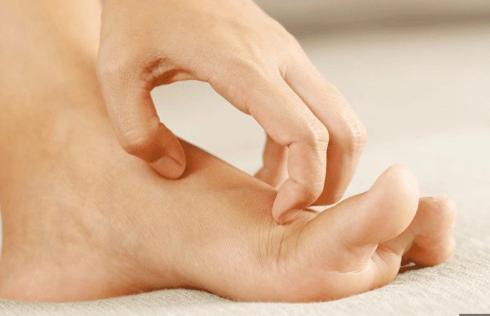 무좀 습진 구별 방법